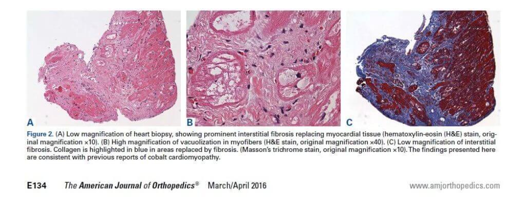 American Journal of Orthopedics page on cardiac problems due to cobalt chromium poisoning