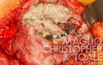 Reactions in a persons hip cavity to the harmful metal particles from defective metal on metal hip replacements