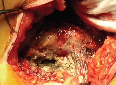 metal poisoning in patient due to defective metal on metal hip replacements